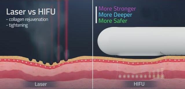 Подмолаживание Smas Ulthera Hifu 3d 4d затягивая машину для лицевого и влагалищного
