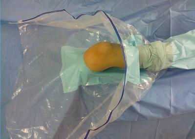O paciente descartável do Arthroscopy do joelho drapeja a classe ortopédica de uma mais baixa extremidade II
