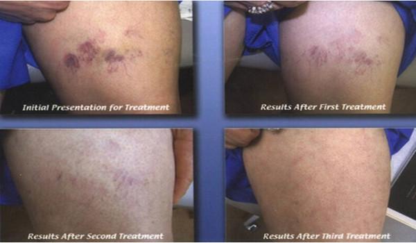 Totally painless 30Mhz painfree RBS laser spider veins laser removal machine
