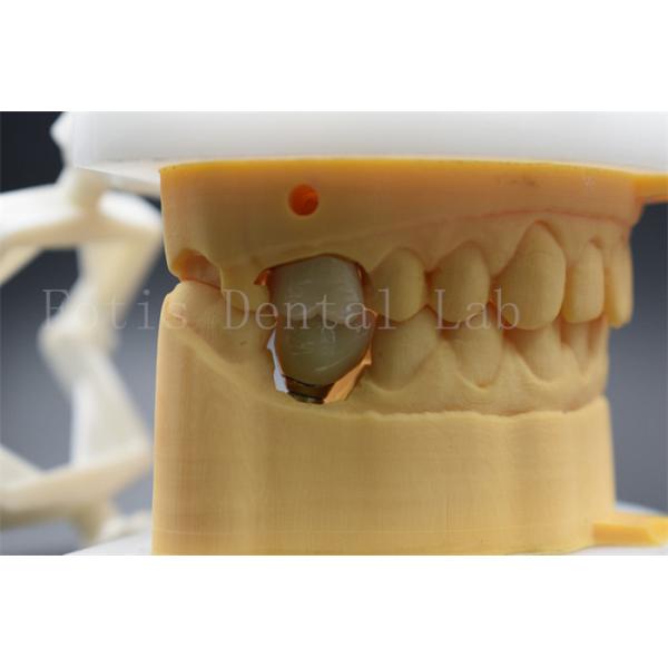 Implante Dental Personalizavel Coroa Abutment Confortável Para Pacientes