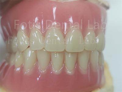 Comfort Custom Fit Full Acrylic Denture For Precise Dental Prosthesis