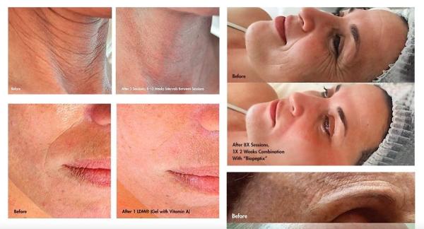 Salão de beleza Máquina de Tratamento de Ultrassonografia LDM Apertar a pele facial