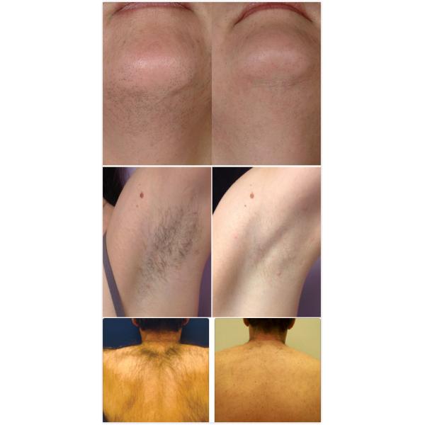 distributor wanted most popular fast hair removal beauty equipment salon use Elight shr ipl