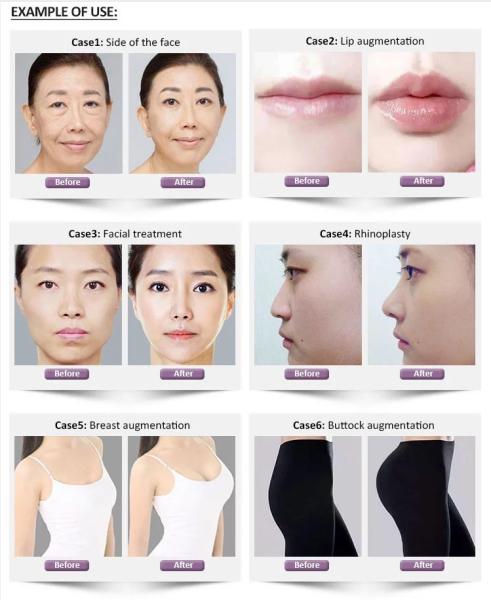 1.1ml Revolax Deep Hyaluronic Dermal Filler For Face