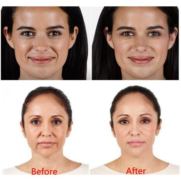 Гель дермального заполнителя Juvederm Ultra4 Hyaluronic кисловочный вводимый