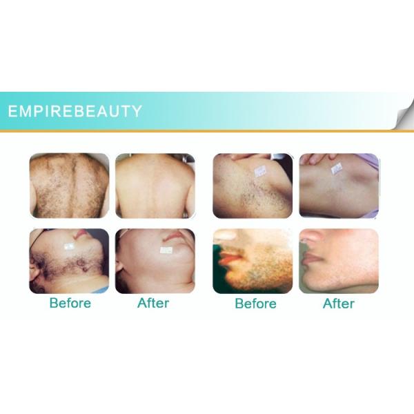 Medical Equipment CE Approved Laser IPL /SHR/ OPT hair removal machine portable ipl