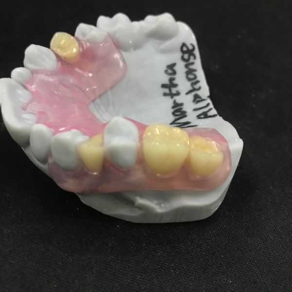 Removable Flexible Denture Valplast Flexible Partial Dentures Prothesis China Dental Lab