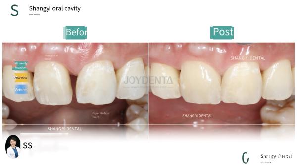 Ceramic For Natural Aesthetics Dental Veneers Stain Resistance Maintains Brightness Strong Bond With Tooth Enamel For Secure Fit