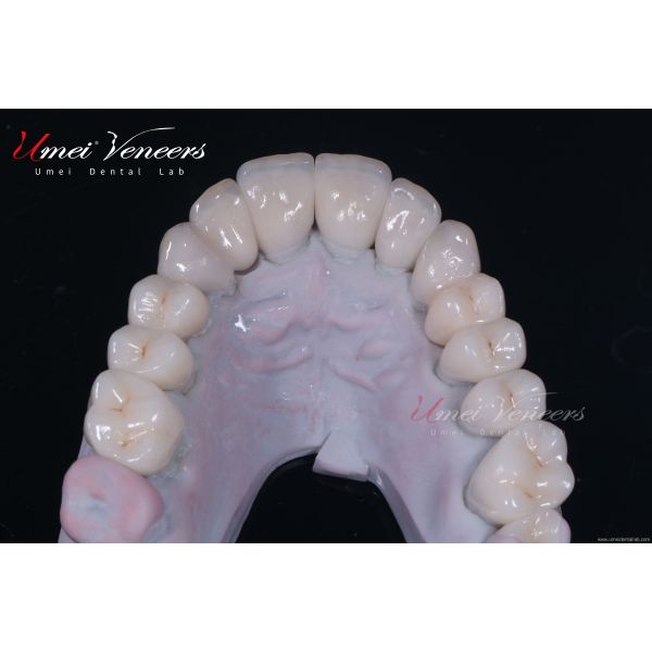 Natural Bright White Veneers