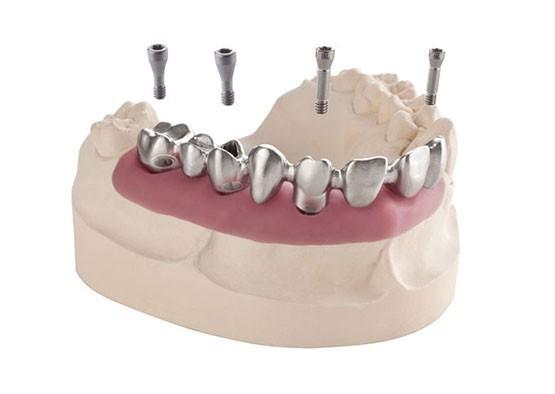 Customized Replacing Dental Implant Crown Wear Resistant For Long Term Use