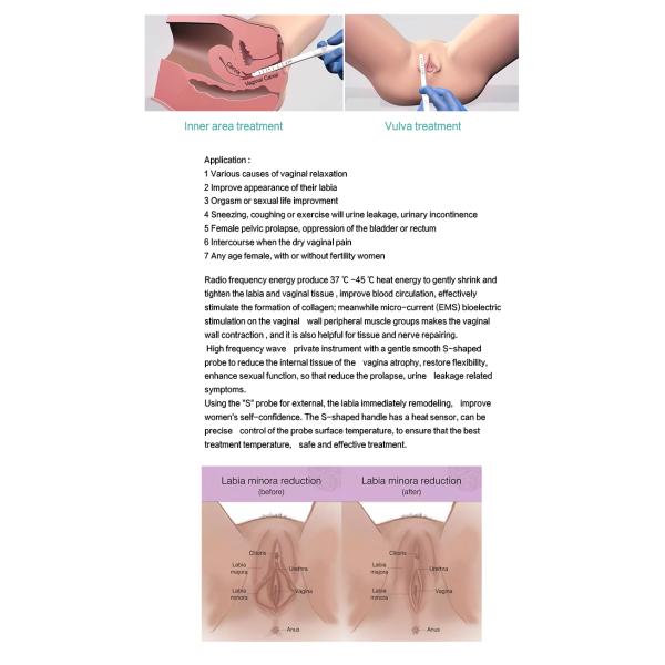 ThermiVaTighten for electrocoagulation of soft tissues for vulvofemale intimate areal laxity women's private area care