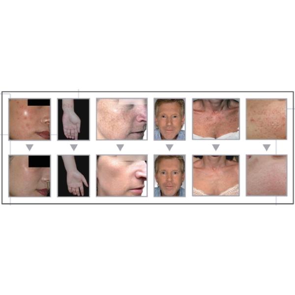 40W CO2 Fractional beauty Laser Equipment For Vaginal Rejuvenation , 33.3 Hz Pulse Frequency