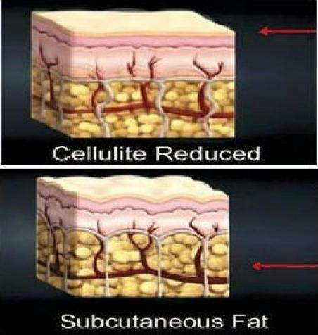 Cuerpo del Rf del vacío del ultrasonido que adelgaza la máquina 40khz de la belleza de la cavitación de la máquina
