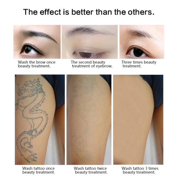 Vertical Type Nd Yag Laser Tattoo Removal Machine 1064 / 532nm Available