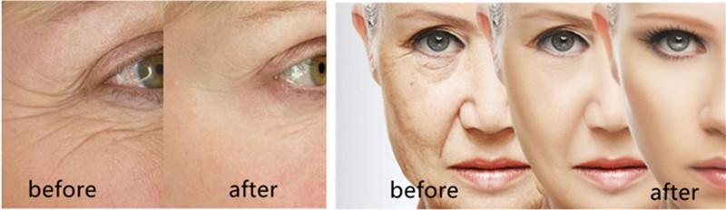 Индукция 220V Microneedling частичный RF коллагена тела