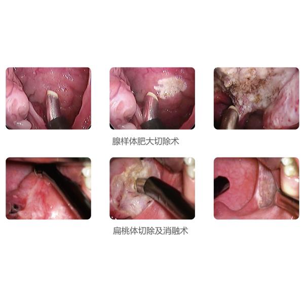 РЧ плазменный хирургический коблатор для тонзилектомии и аденоидектомии