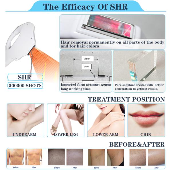 Germany medical use handle pipe whole body treatment opt shr ipl hair removal device