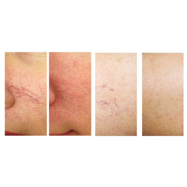 1-5hz Home Spider Vein Removal Laser 980nm , Vascular Removal Machine CE Approval