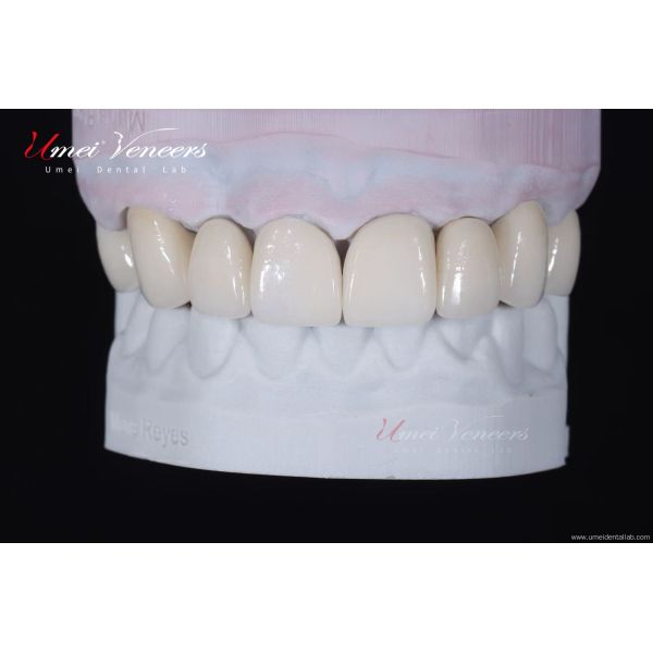 Strong and thin aesthetic veneers