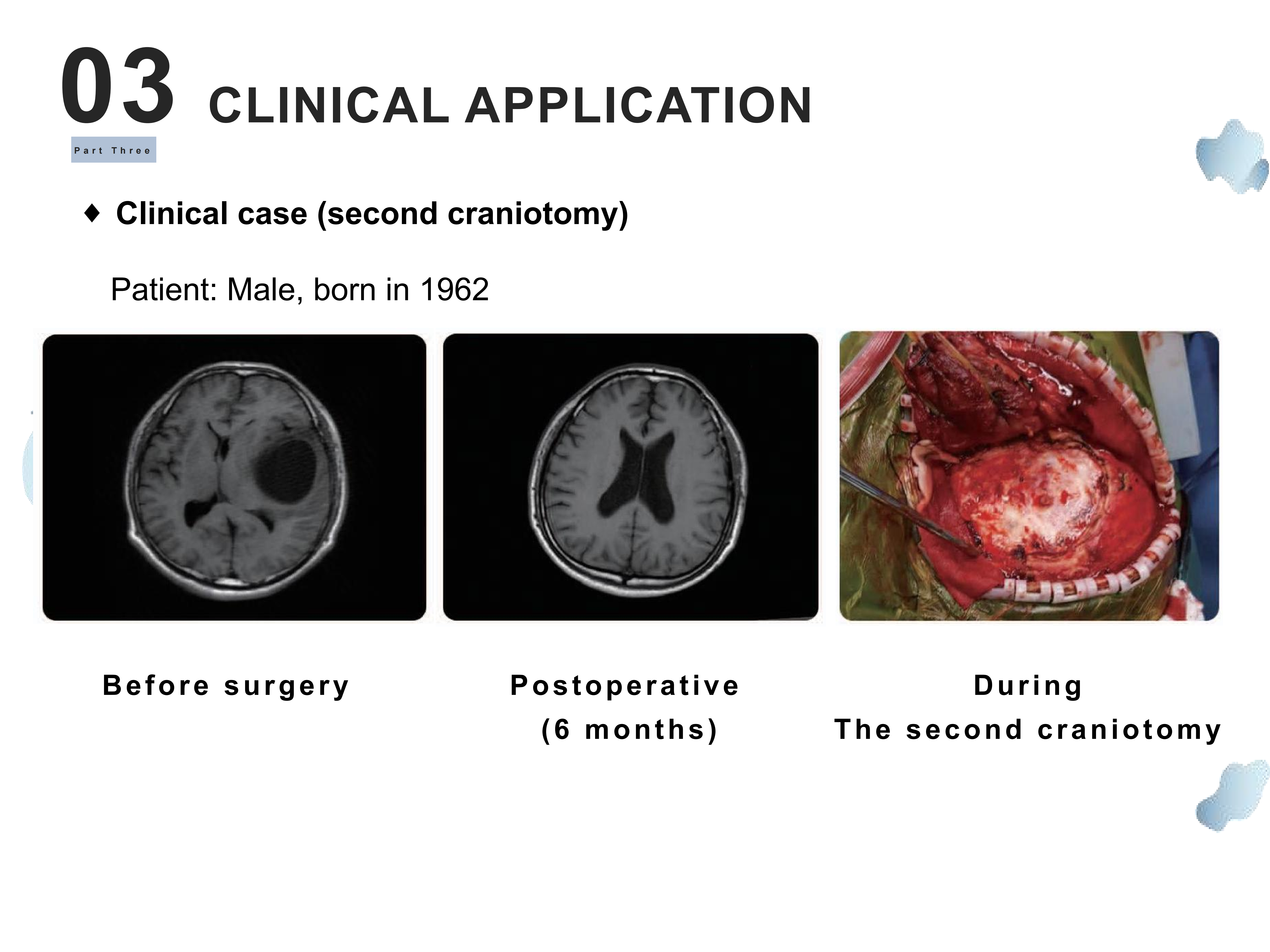 Dura Substitute Non Sutured Tissue Regeneration
