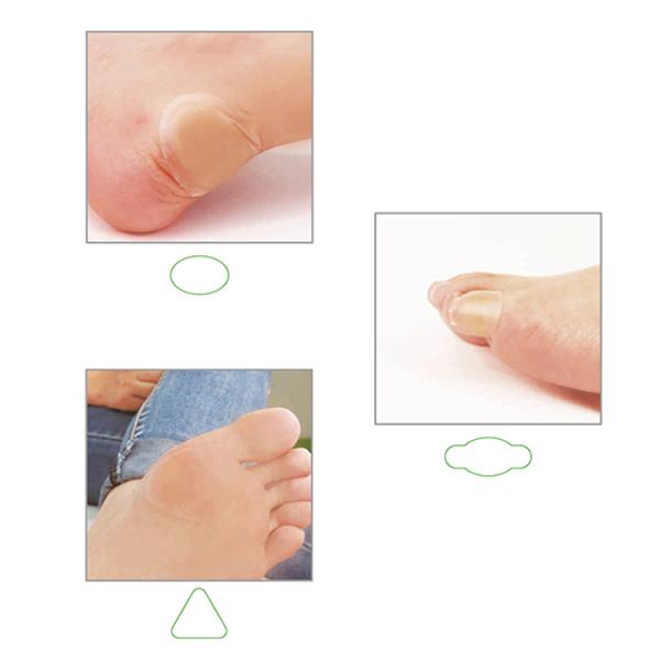 Disposable Medical Kind Removal Foot Care Adhesive Hydrocolloid  Plaster