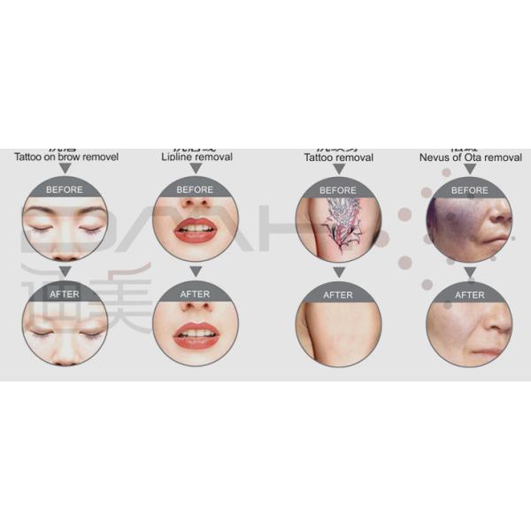 Proable Q Switched ND YAG Laser for fast removing tattoo on sale