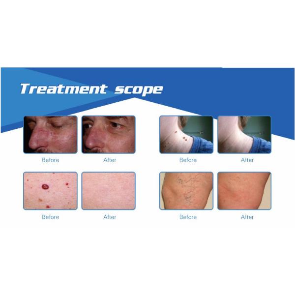 Top quality touching screen 635nm infrared ray varicose veins blood vessel removal laser diode 980nm