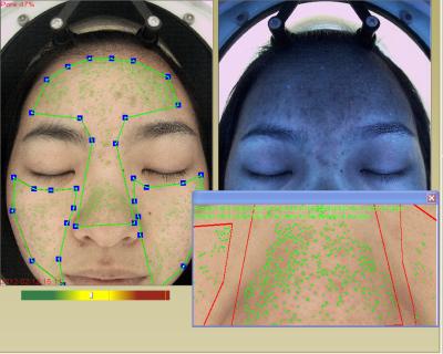 A camada portátil da derma do cosmético da análise da pele e do terapeuta da pele detecta