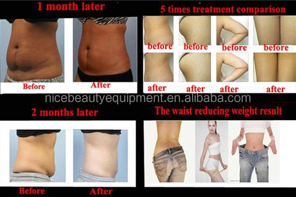 Home Body Shaping 650nm Lipo Laser Beauty Machine