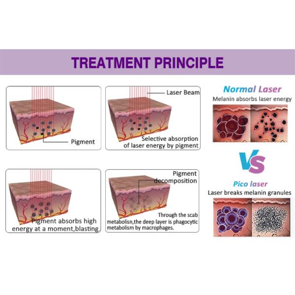пикосекунда q 755nm 1320nm переключила машину удаления татуировки лазера ND YAG