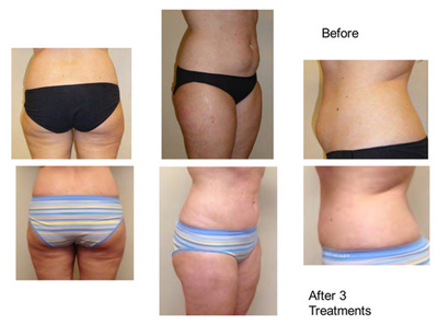 Effective HIFU Skin Tightening Machine  Liposuction 620 shots cartridge