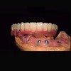 Choose China Dental Implants for Permanent and Reliable Solution to Missing Teeth with Wholesale Prices