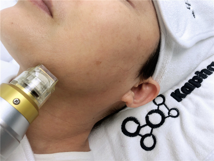 Термальный охлаждая подниматься стороны Microneedling частичный RF 10,4 дюймов