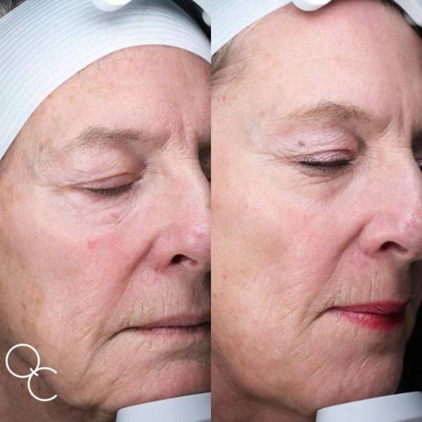 Serrage de la machine partielle de beauté de laser de CO2 de peau pour le retrait de cicatrice de colorant d'acné