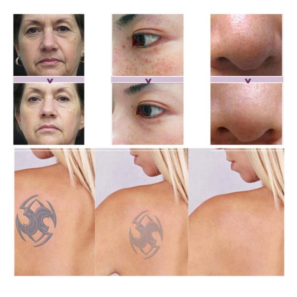 Permanent Laser Tattoo Removal Equipment Birth Mark Removal Adjustable Facular