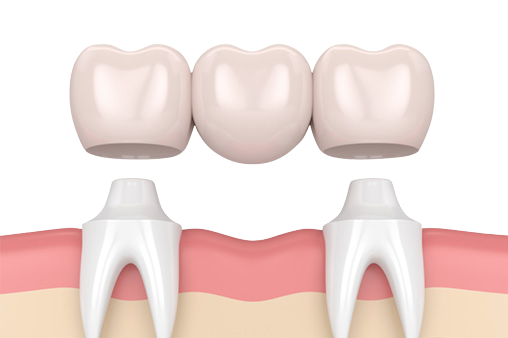 Oral Hygiene Safety Porcelain Tooth Crown High Wear Resistance High Finish