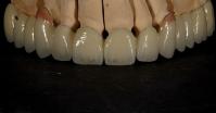 Bon ajustement Bonne esthétique Couronne en zirconium à plusieurs couches Porcelaine Pont en zirconium