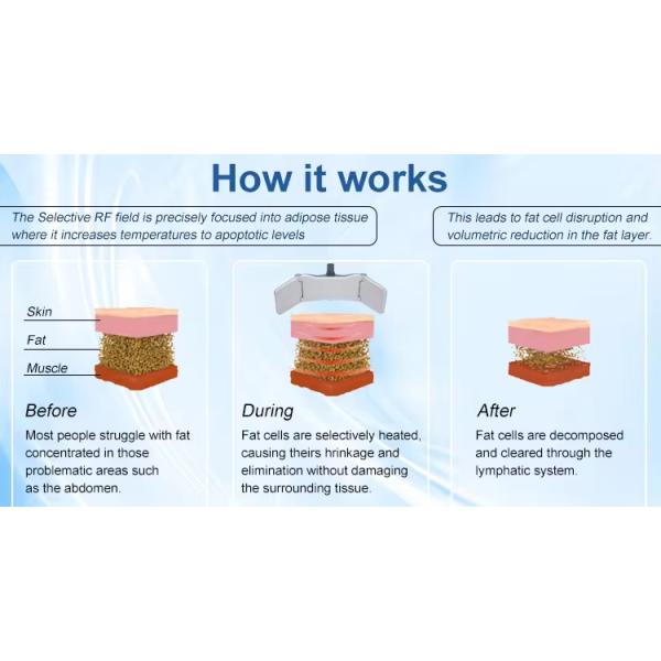 Бесконтактная площадь тела Снижение жировых отложений Скульптура тела Устройства для похудения для домашнего использования и салона красоты