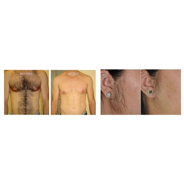 Effective Laser Beauty Machine Elight IPL For All Color Hairs Customized