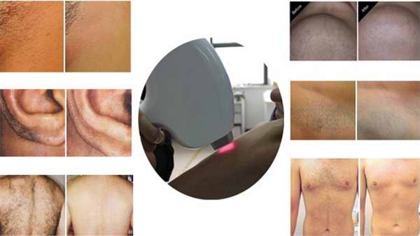 diode laser hair removal machine super cooling system make sure the machine nonstop work 12 hours