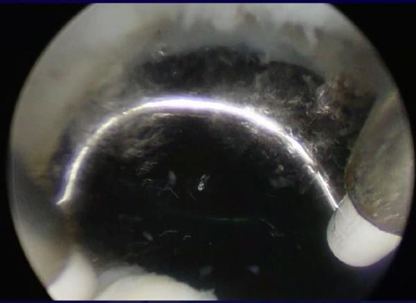 BPHおよび他の泌尿器科学の病気のための無線周波数血しょう外科電極