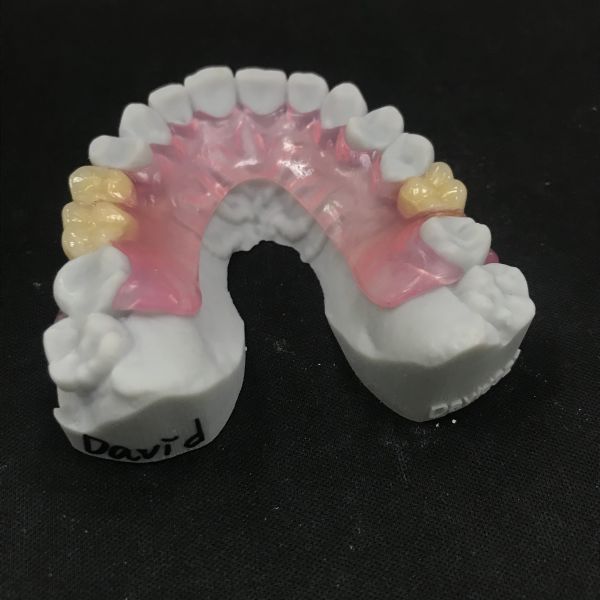 Removable Flexible Denture Valplast Flexible Partial Dentures Prothesis China Dental Lab