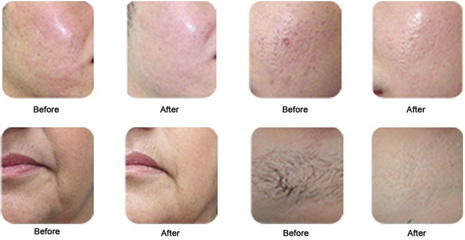 Самый лучший прибор EpiMED- красотки удаления волос цены SHR