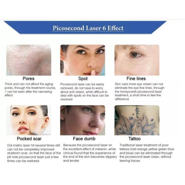 Picosure Q Switched Nd Yag Laser Tattoo Removal / Pigmentation Removal Machine