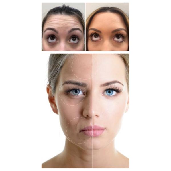 Type anti soins de la peau de Hyamely d'injection de Botox de rides d'A