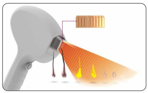 surface mount laser diode 808nm diode laser FMD-1 diode laser hair removal machine