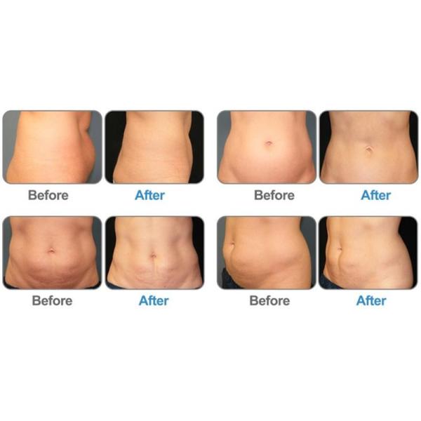 Машина Protable Cryolipolysis жирная замерзая для тела Cryo уменьшая домашнюю пользу