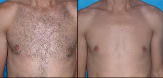 AFT EDF Shr Ipl Laser Hair Removal Equipment For Beauty Salon