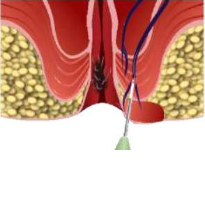 Dual Wavelength Laser 980nm 1470nm for Anal Fistula Hemorrhoid Proctology
