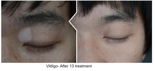 308nm Targeted Laser Treatment Vitiligo Excimer Light Phototherapy